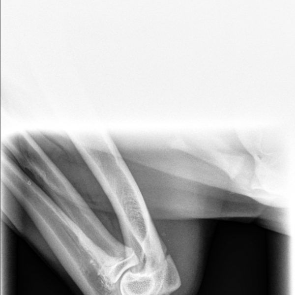 Adsila left elbow elbow b